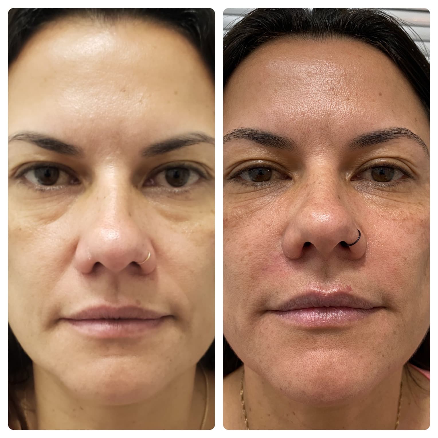 Preenchimento de olheiras - antes e depois