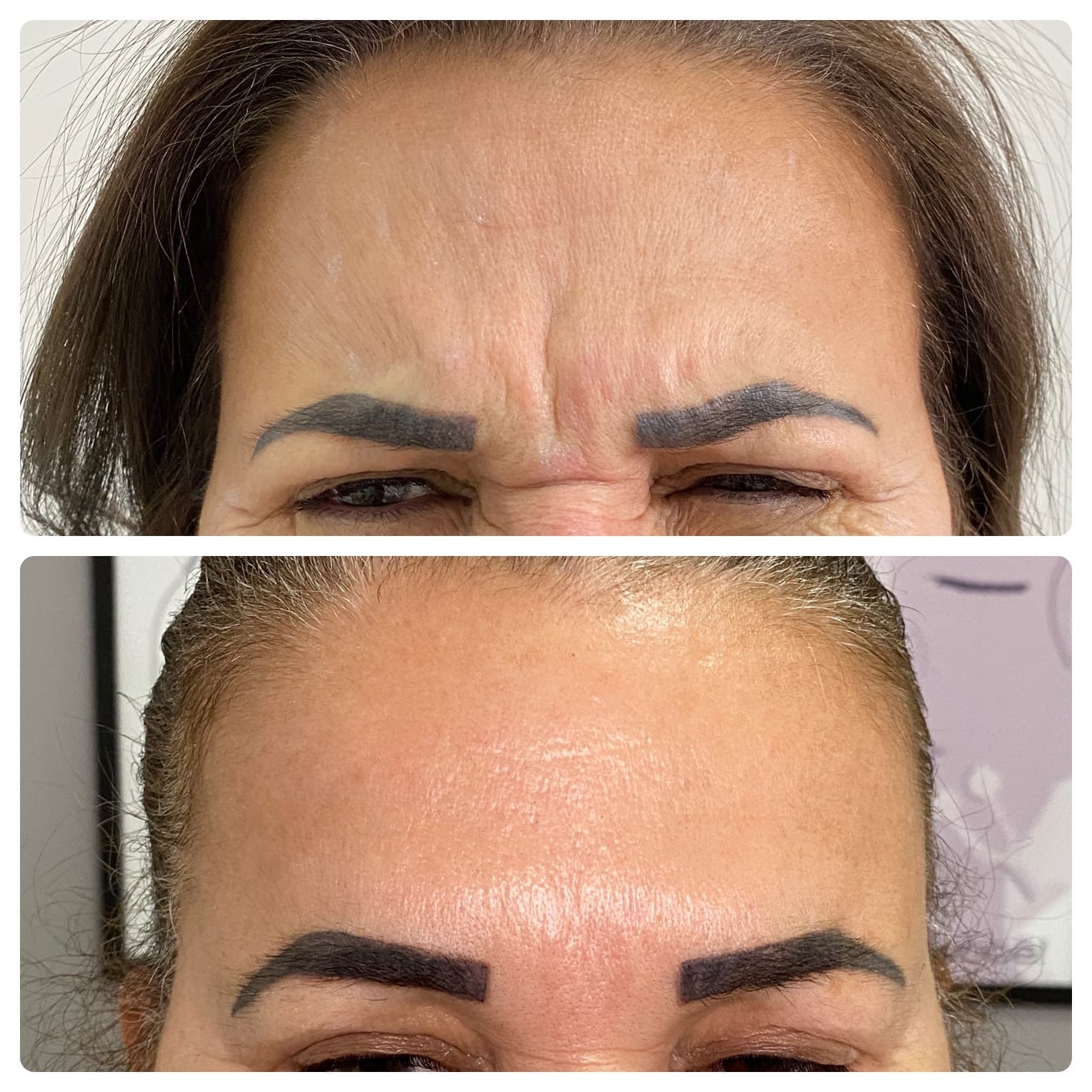 Botox - antes e depois