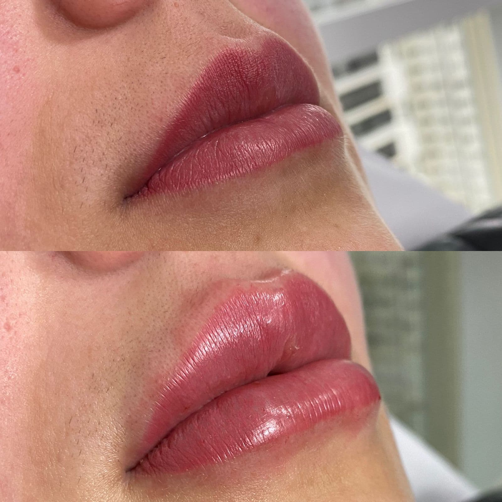Preenchimento de labios - antes e depois