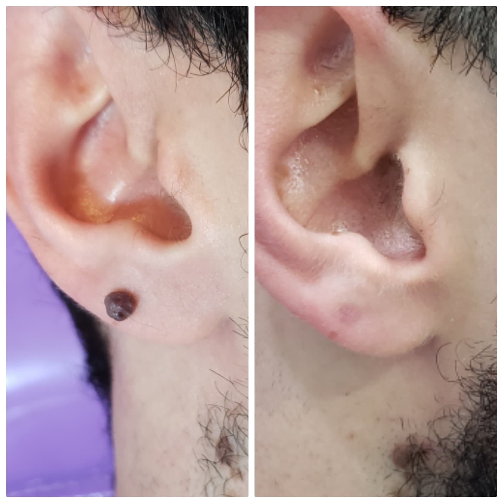 Remoção de verrugas - antes e depois