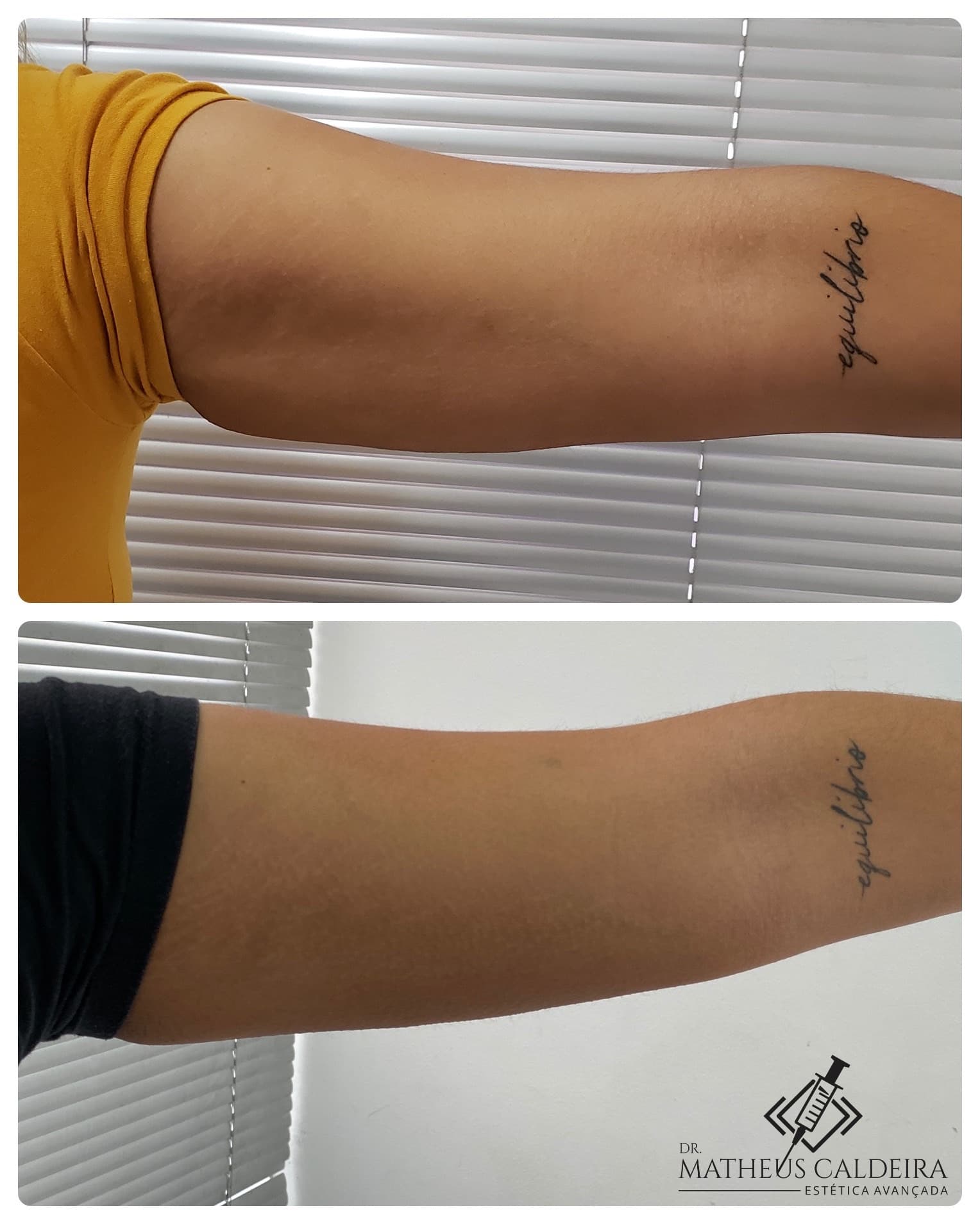 Redução de gordura localizada no braço - antes e depois